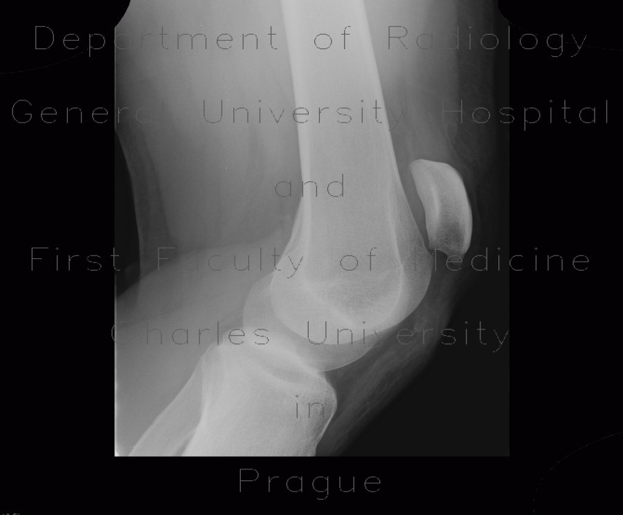 Rupture of patellar ligament