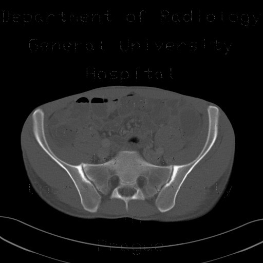 Sacroileitis in Crohn's disease