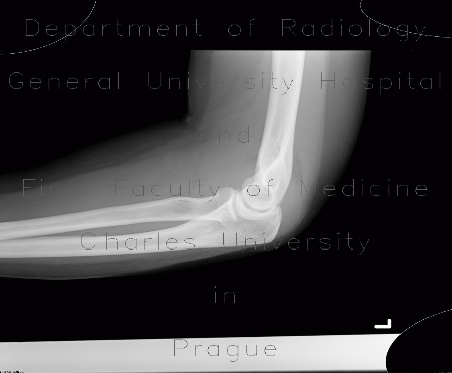 Sail sign, elbow, joint effusion