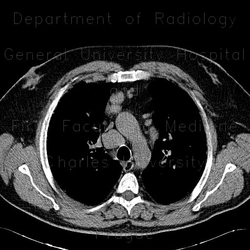 Sarcoidosis of lung, HRCT, hilar lymphadenopathy
