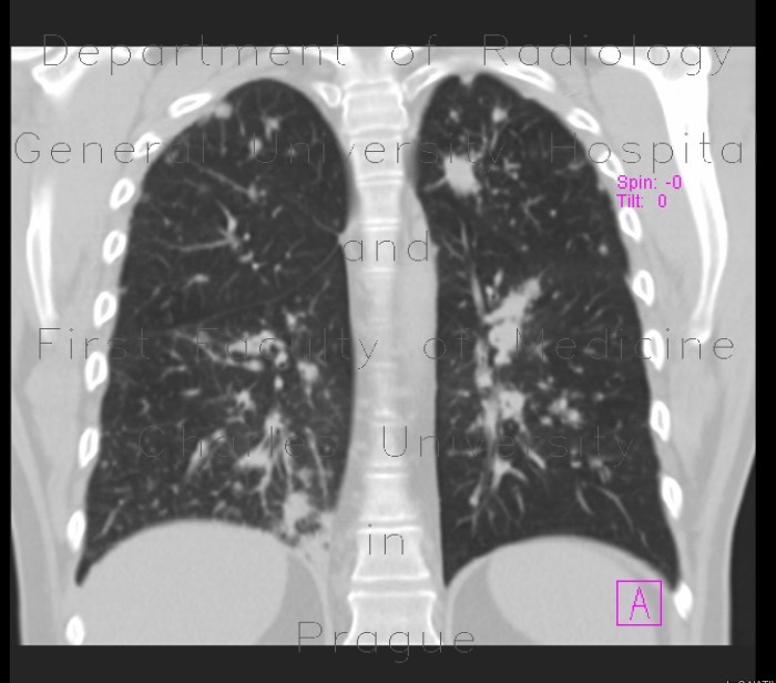 Sarcoidosis, pulmonary