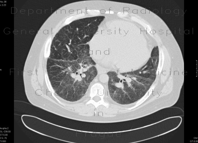 Sarcoidosis, second stage