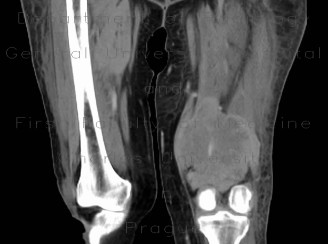 Sarcoma of thigh