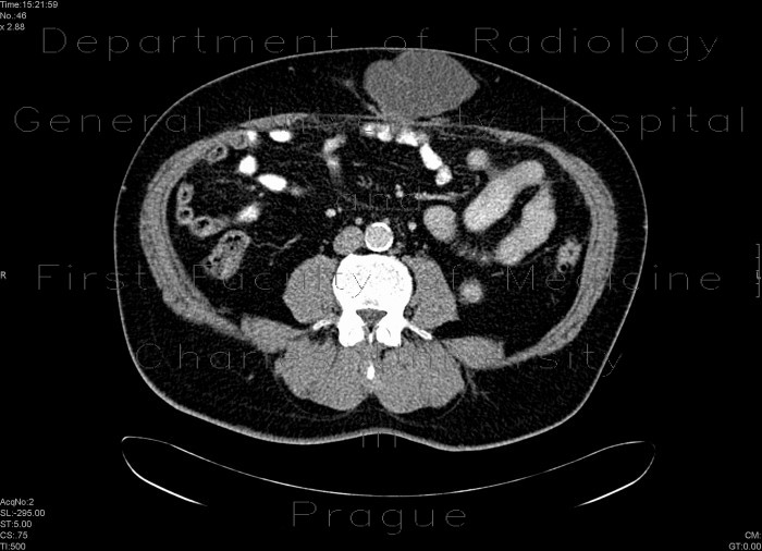 Scar hernia after laparoscopy