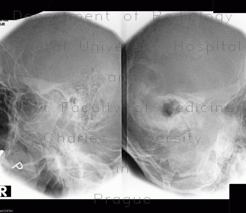 Schuller view, antrotomy