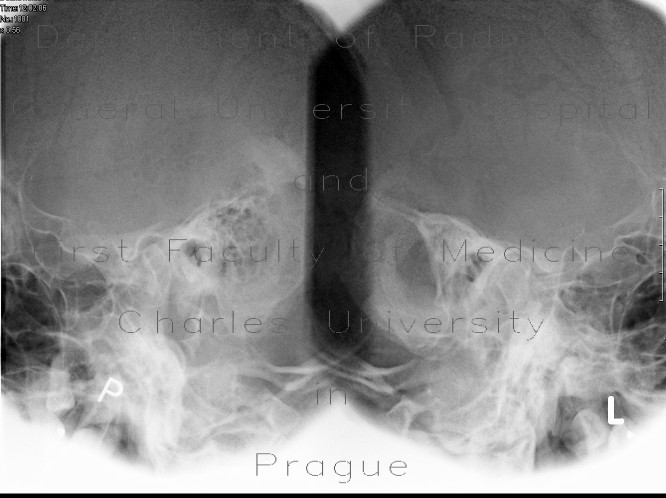 Schuller view, chronic mastoiditis