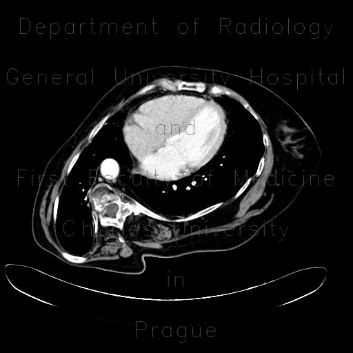 Scoliosis of thoracic spine, severe