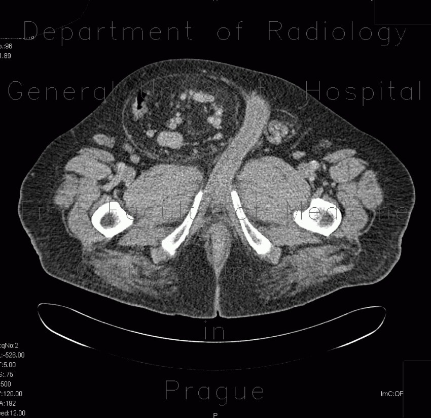 Scrotal hernia