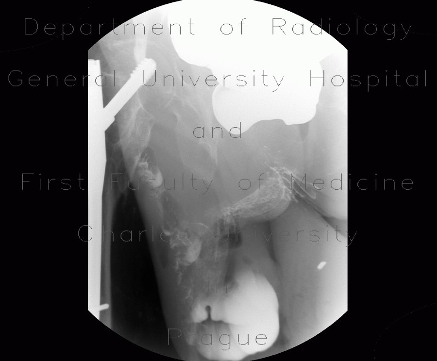 Scrotal hernia, cecum in scrotal hernia