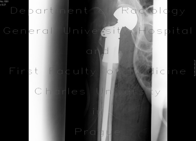 Scrotal hernia, hip joint replacement