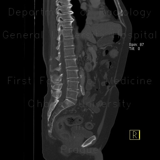 Separate apophysis of spinous process, lumbar vertebra