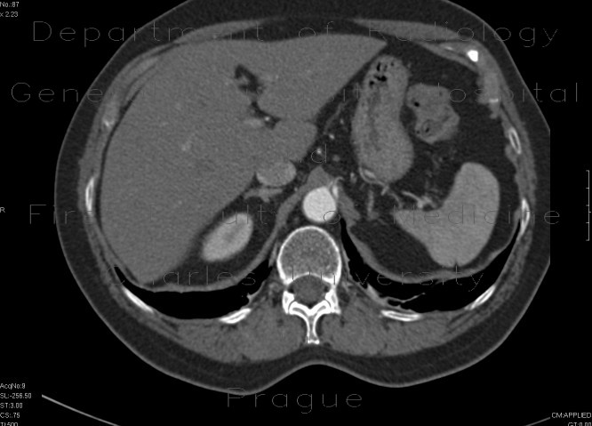 Separate branching of the hepatic and lienal artery from aorta