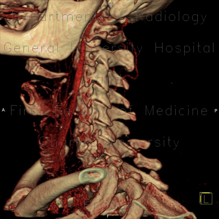 Separation of spinous process of C6 and C7, congenital