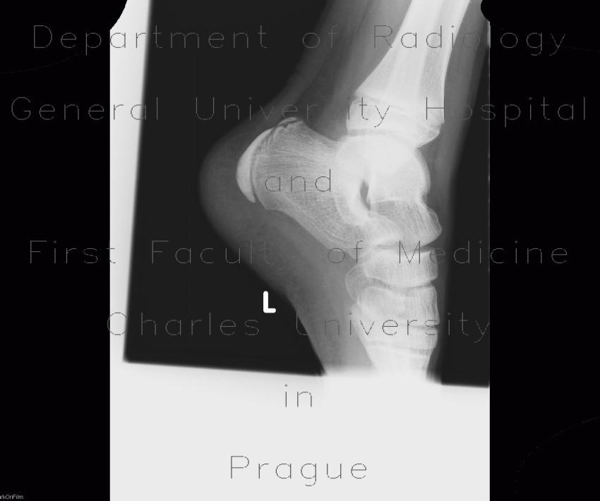 Sever's disease, calcaneal apophysitis
