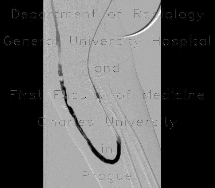 Shunt stenosis, angioplasty