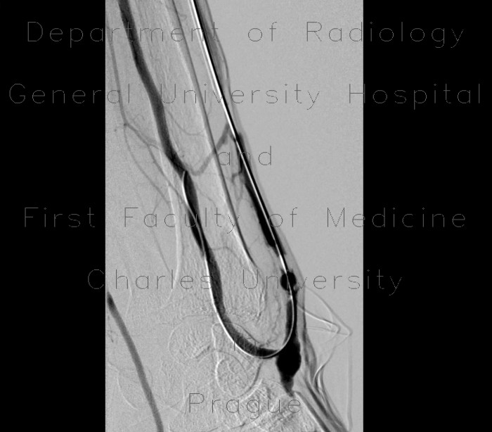 Shunt stenosis, angioplasty, native shunt