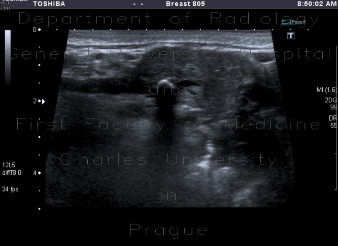 Sialolithiasis