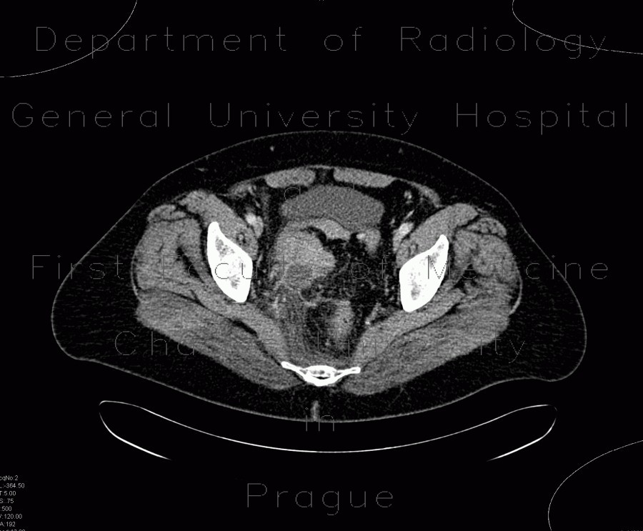 Sigmoid adenocarcinoma, peritoneal metastasis