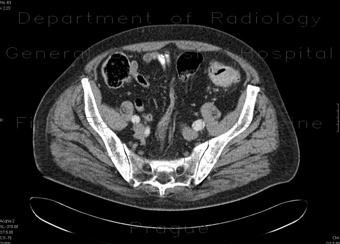 Sigmoid carcinoma, polyp of the ascending colon