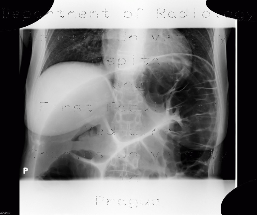 Sigmoid volvulus, ileus