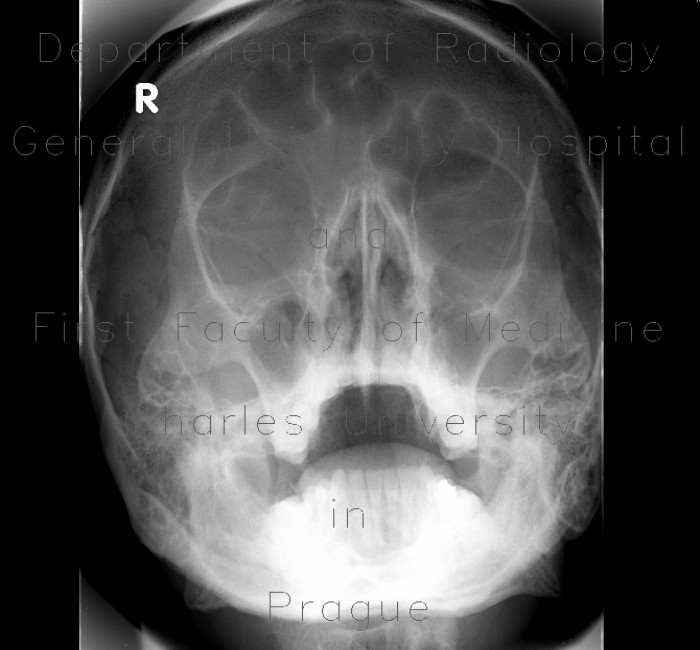 Sinusitis