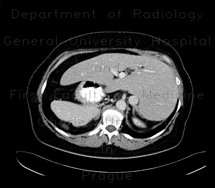 Situs viscerum inversus