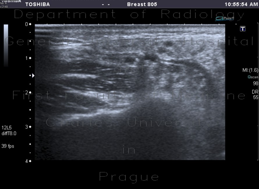 Sjogren syndrom, sialolithiasis, parotid gland