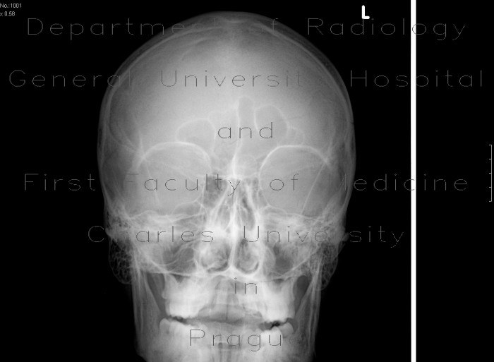 Skull fissure
