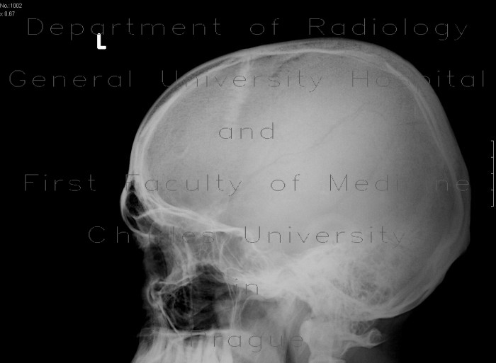 Skull fissure, epidural hematoma