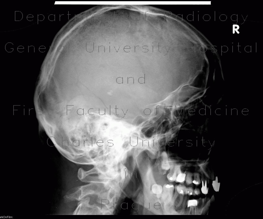 Skull fissure, temporal bone, occipital bone