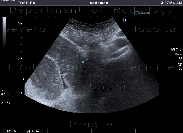 Small bowel ileus