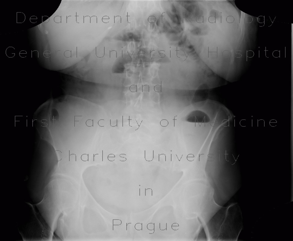 Small bowel obstruction, ileus, Crohn's disease