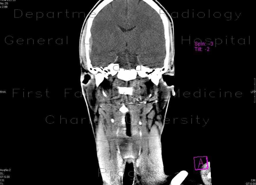 Small epidural hematoma