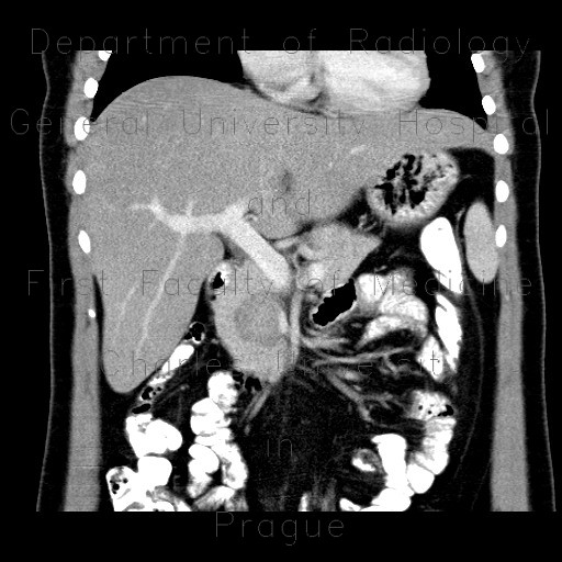 Solid pseudopapillary tumor of pancreas