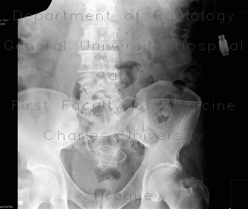 Spina bifida of lumbar vertebra
