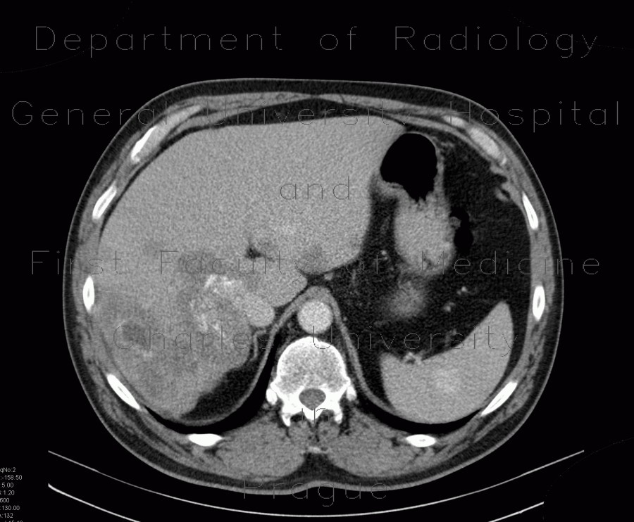 Splenic hemangioma, liver metastases, colon carcinoma