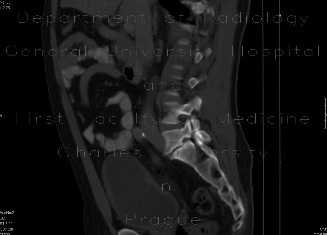Spondylolisthesis, isthmic spondylolysis