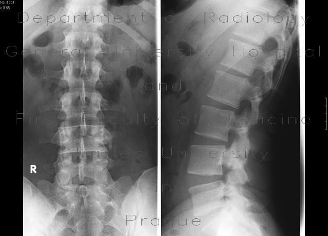 Spondylolysis, lumbar vertebra