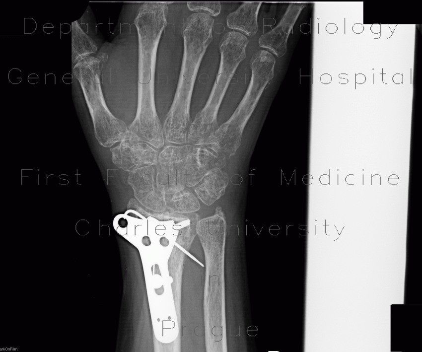 Spotty porosis, fracture of distal radius