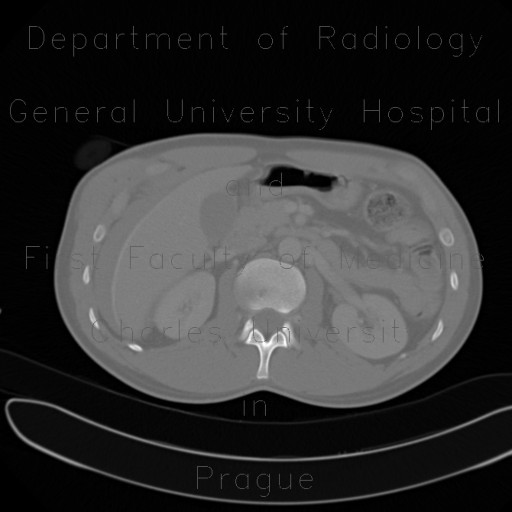 Stab wound of liver with active bleeding, hemorrhage