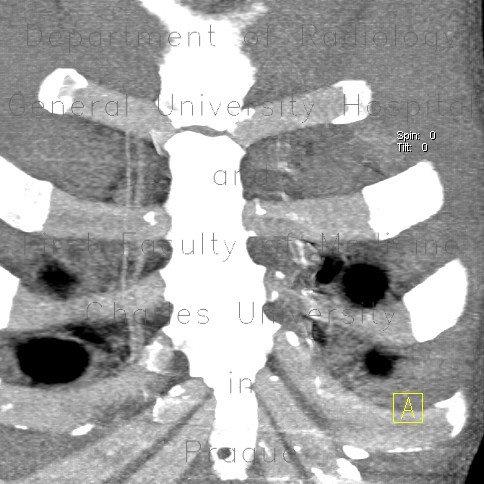 Stab wound of thorax, internal mammary artery and aortic arch, mediastinal hemorrhage, hemothorax