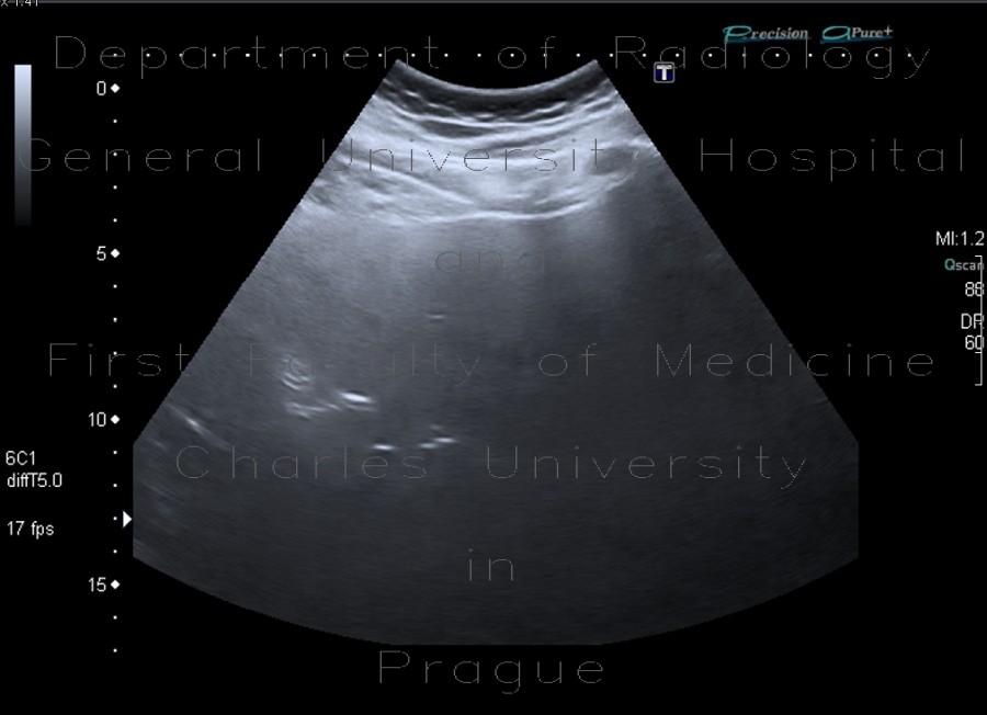 Steatosis of liver, steatosis hepatis, fatty liver, parenchymal sparing