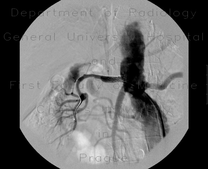 Stenosis of renal artery, stent