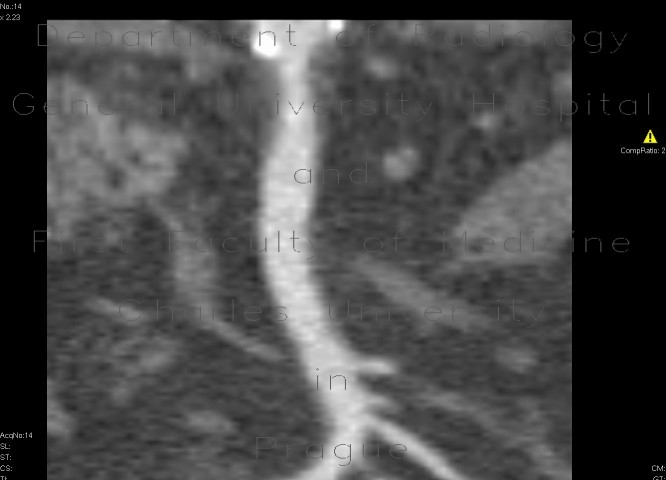 Stenosis of the superior mesenteric artery, AMS