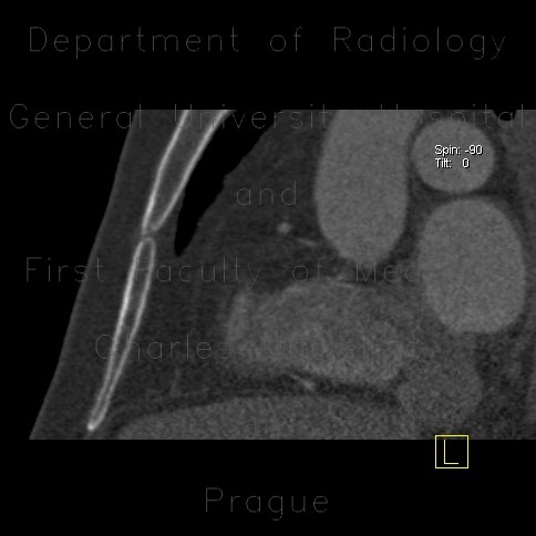 Sternal foramen