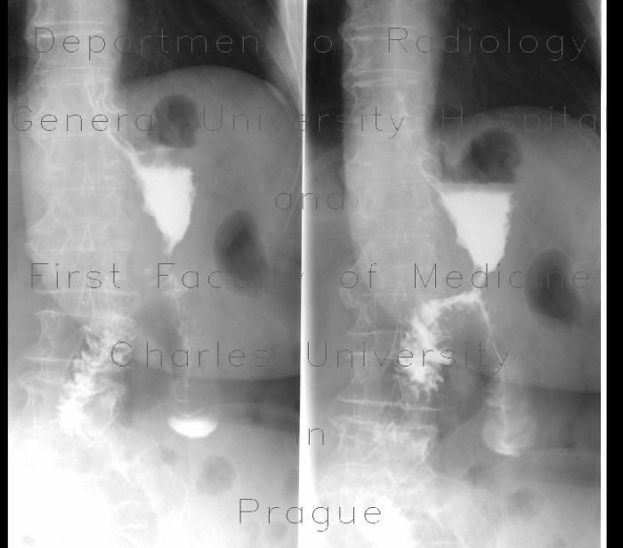 Stomach resection, Billroth II