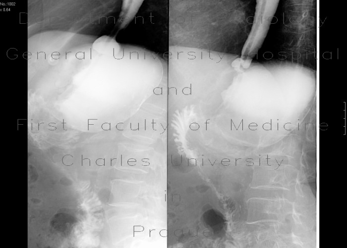 Stomach resection, Billroth II, hiatal hernia