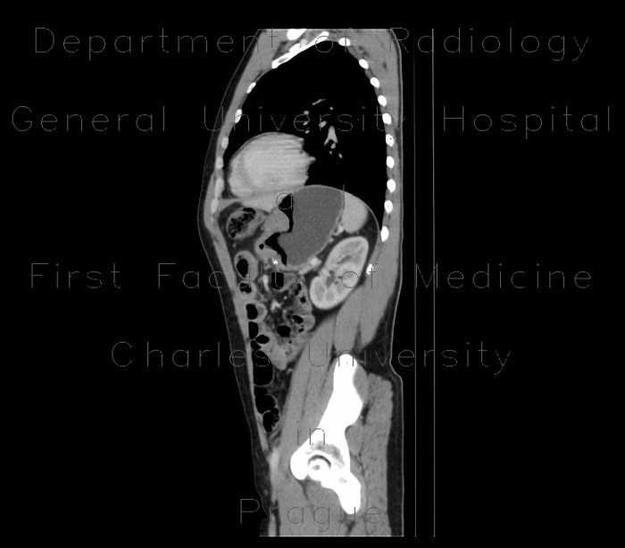 Stomach tumour
