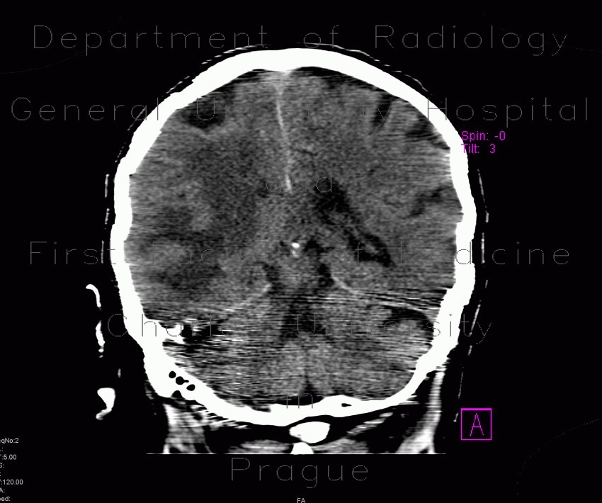 Stroke, cerebral ischemia, acute stage, MCA, medial cerebral artery