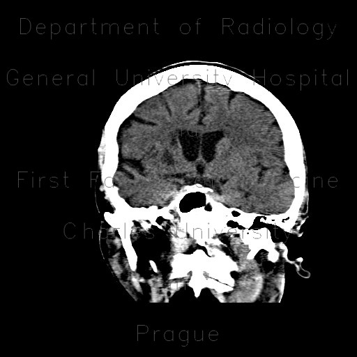 Stroke, cerebral ischemia, insula, caudate